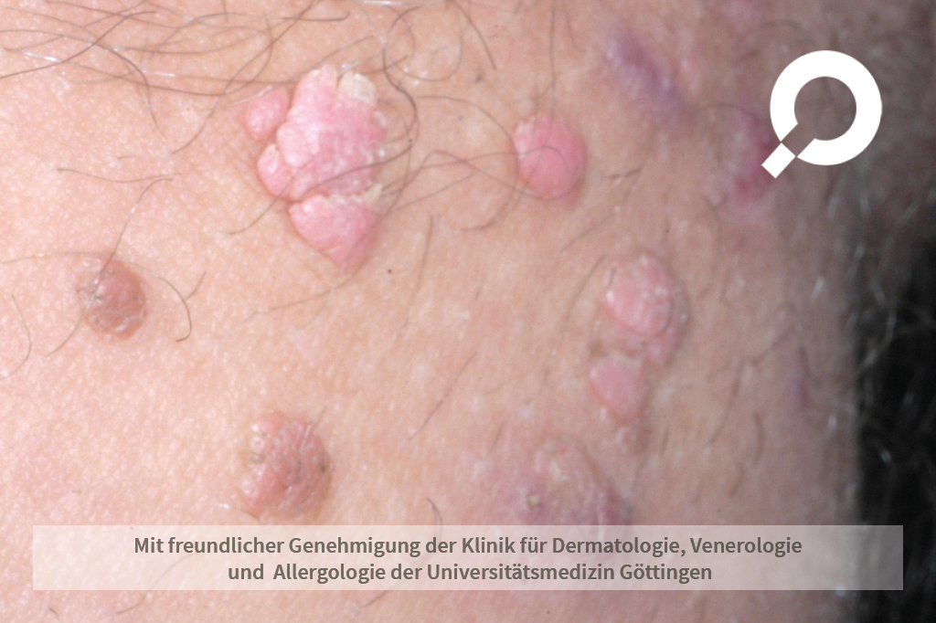 imiquimod rezeptfrei kaufen