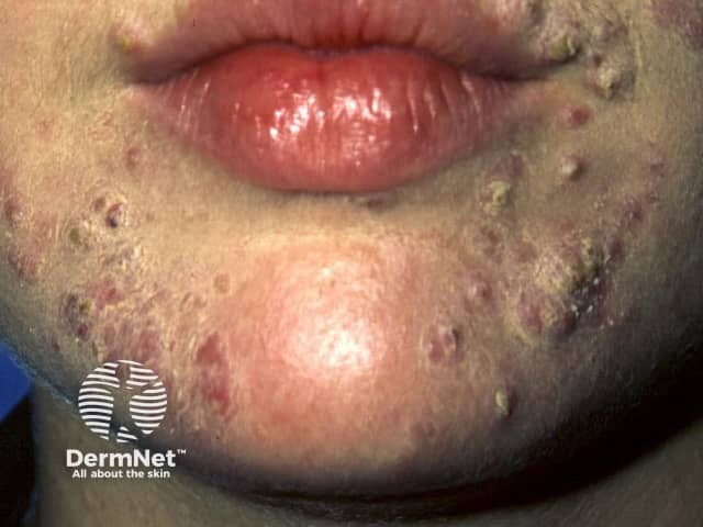Isotretinoin Bnf Online