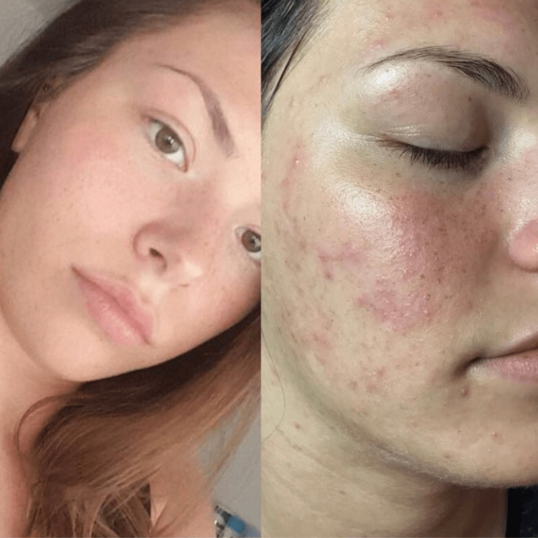 Isotretinoin Nach Pille Absetzen