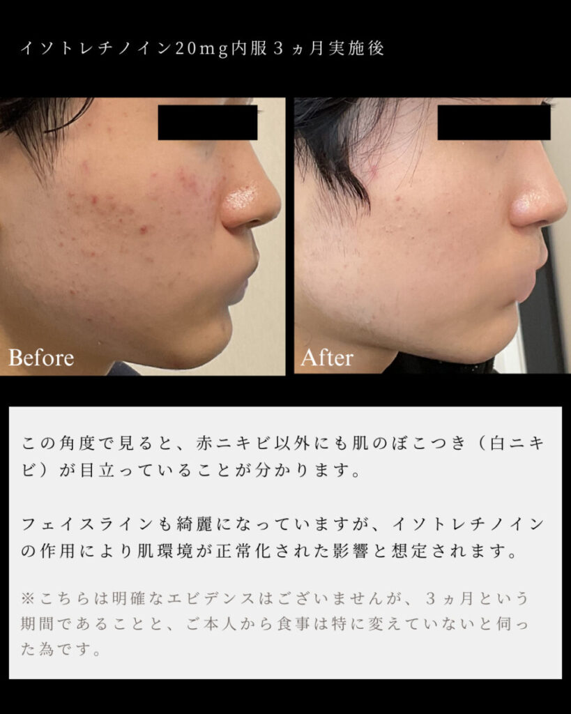 Kosten Für Roaccutane