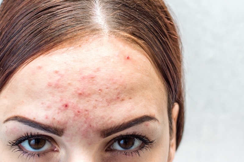 preis für accutane