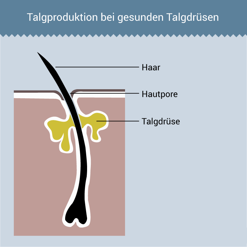 roaccutan gel rezeptfrei