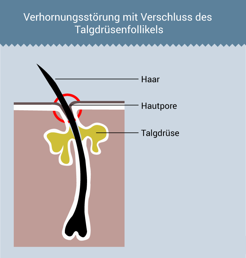 roaccutan kauf