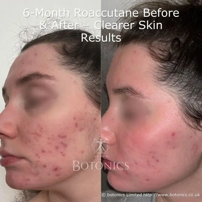 Roaccutane Generika