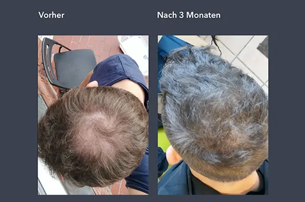 Wie man proscar kauft